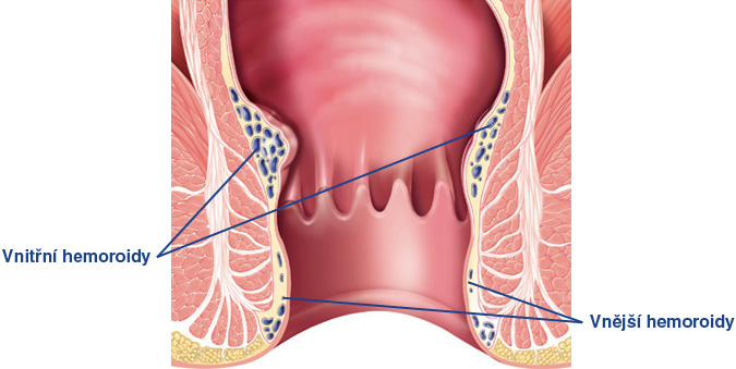 co-jsou-hemoroidy