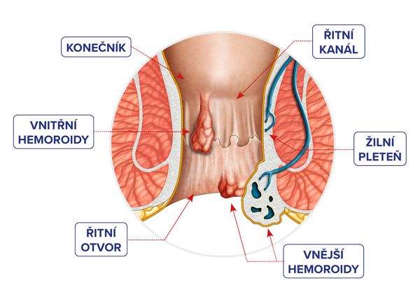 Obr. 1. Anatomická lokalizace vnitřních a vnějších hemoroidálních pletení při jejich zbytnění